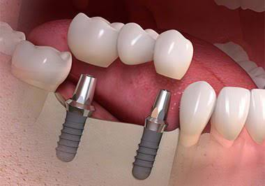 6 Leading Zirconia Dental Implant Providers Serving New York City, Westchester, And Connecticut